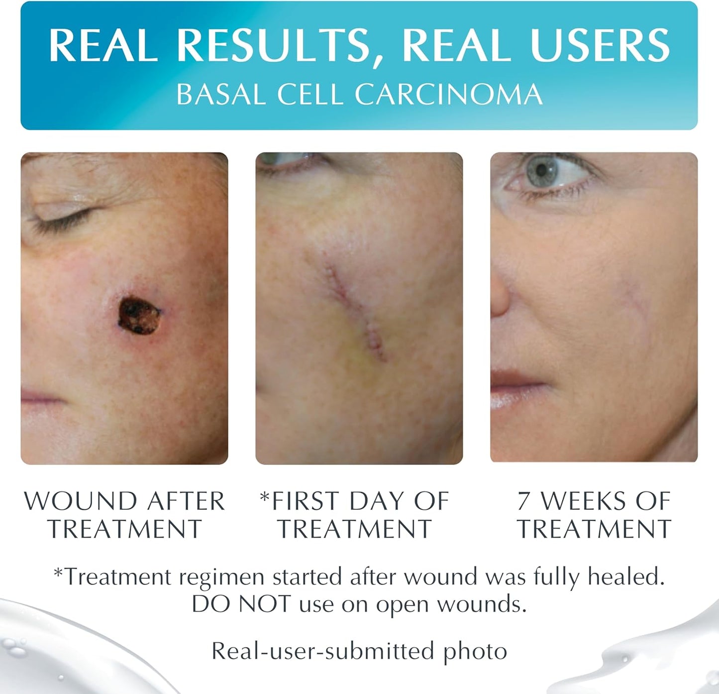 NewGel+E Advanced Silicone Gel for Scars - 15 Grams